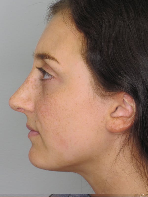 Rhinoplasty Before & After Gallery - Patient 11109910 - Image 8