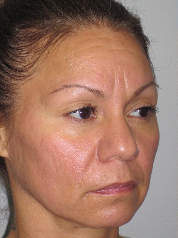 Rhinoplasty Before & After Gallery - Patient 11109912 - Image 3