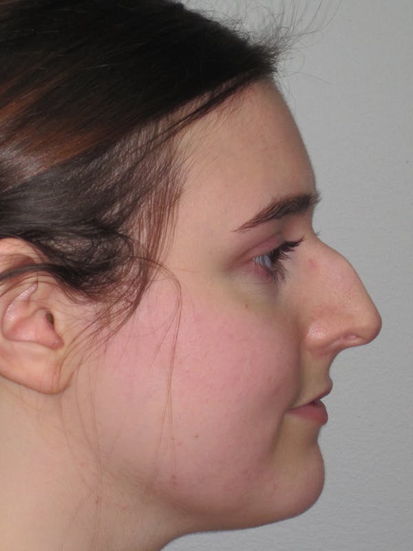 Rhinoplasty Before & After Gallery - Patient 11109911 - Image 5