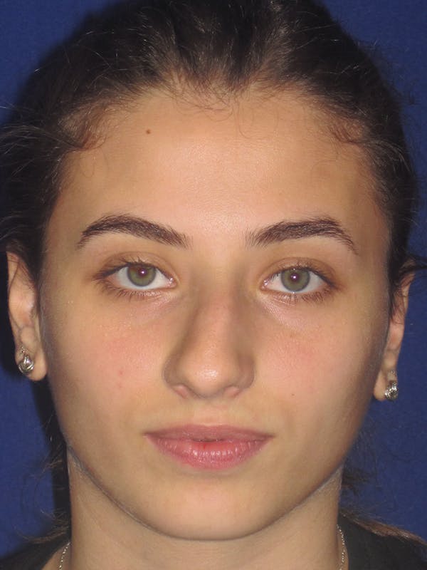 Rhinoplasty Before & After Gallery - Patient 11109913 - Image 1