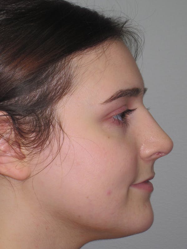Rhinoplasty Before & After Gallery - Patient 11109911 - Image 6