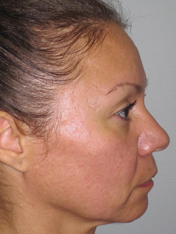 Rhinoplasty Before & After Gallery - Patient 11109912 - Image 5