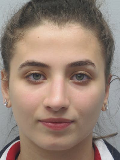 Rhinoplasty Before & After Gallery - Patient 11109913 - Image 2