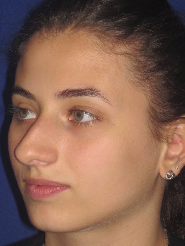 Rhinoplasty Before & After Gallery - Patient 11109913 - Image 7