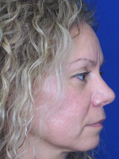 Rhinoplasty Before & After Gallery - Patient 11109912 - Image 6