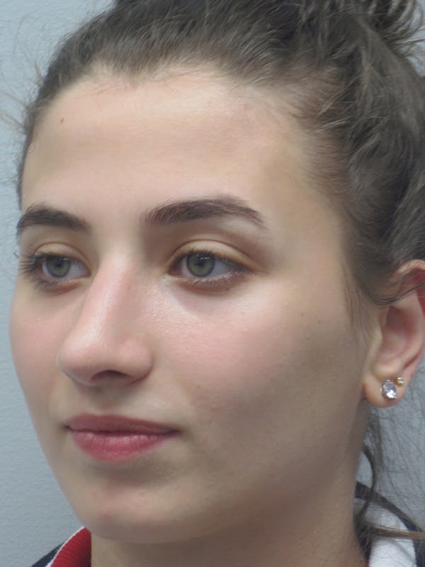 Rhinoplasty Before & After Gallery - Patient 11109913 - Image 8