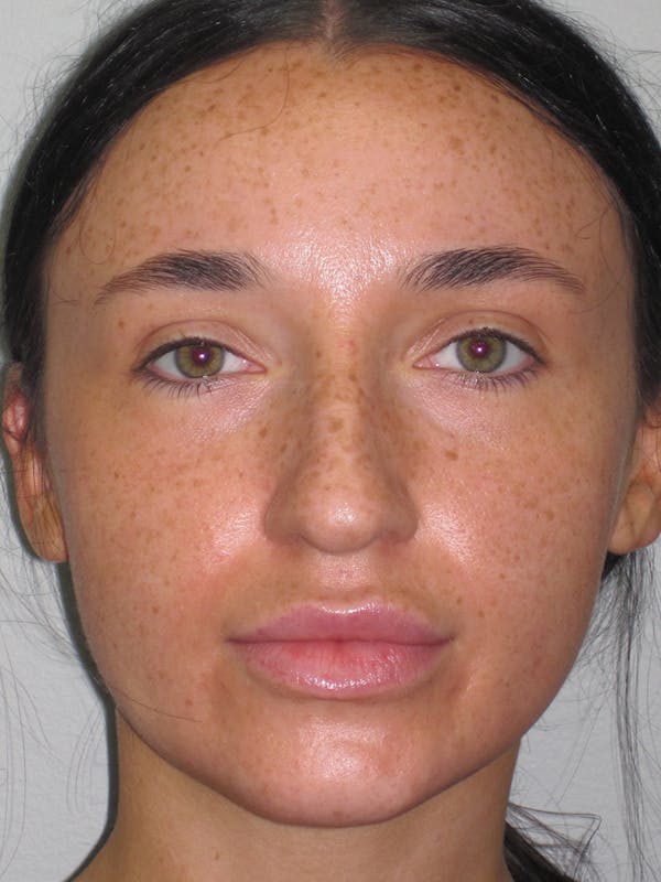 Rhinoplasty Before & After Gallery - Patient 11109914 - Image 5