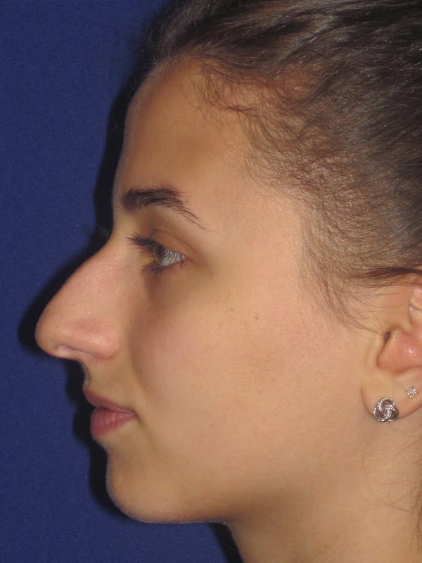 Rhinoplasty Before & After Gallery - Patient 11109913 - Image 5
