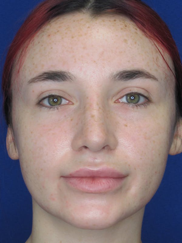 Rhinoplasty Before & After Gallery - Patient 11109914 - Image 6