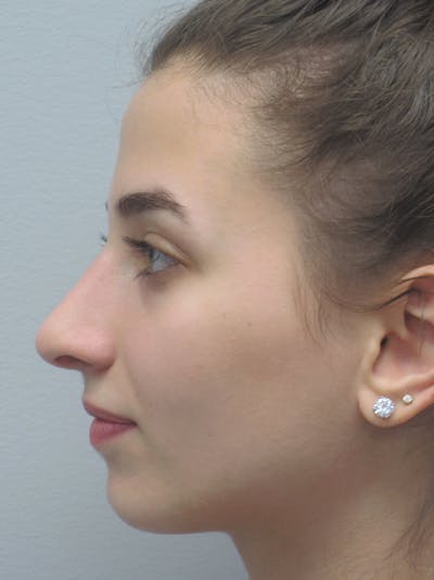 Rhinoplasty Before & After Gallery - Patient 11109913 - Image 6
