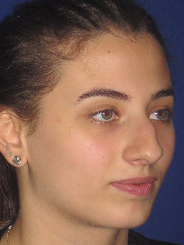 Rhinoplasty Before & After Gallery - Patient 11109913 - Image 3