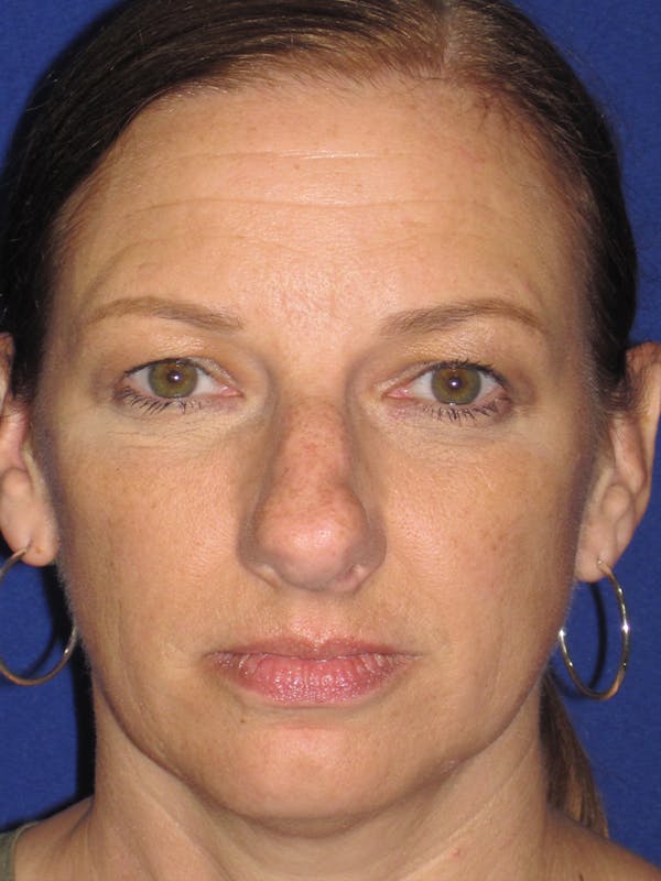 Rhinoplasty Before & After Gallery - Patient 11109915 - Image 5