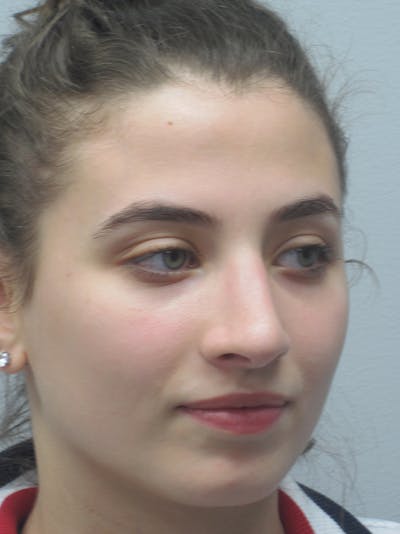 Rhinoplasty Before & After Gallery - Patient 11109913 - Image 4