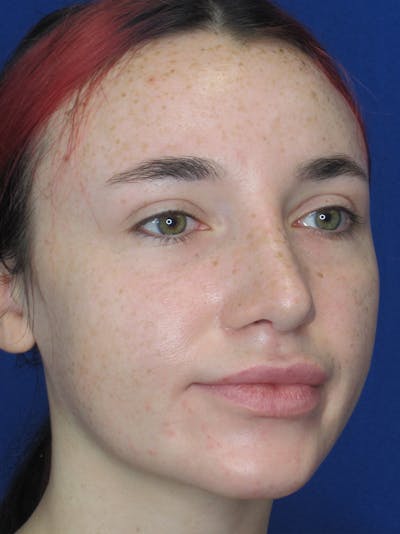 Rhinoplasty Before & After Gallery - Patient 11109914 - Image 4