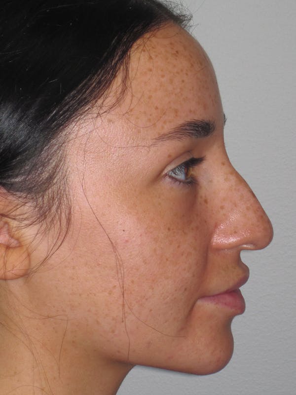 Rhinoplasty Before & After Gallery - Patient 11109914 - Image 1