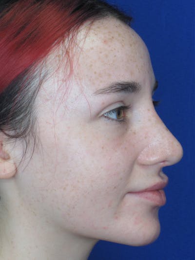 Rhinoplasty Before & After Gallery - Patient 11109914 - Image 2