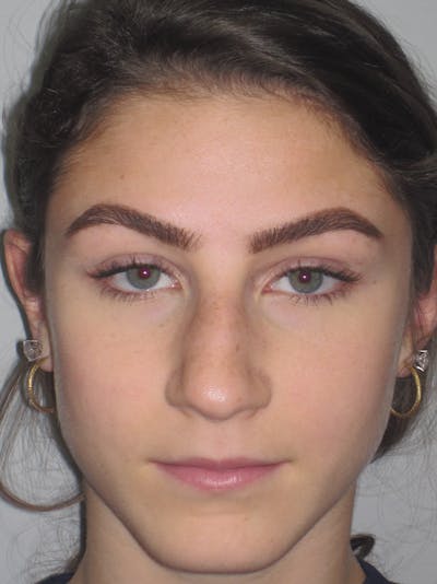 Rhinoplasty Before & After Gallery - Patient 11109916 - Image 1