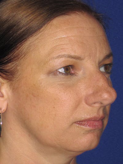 Rhinoplasty Before & After Gallery - Patient 11109915 - Image 1