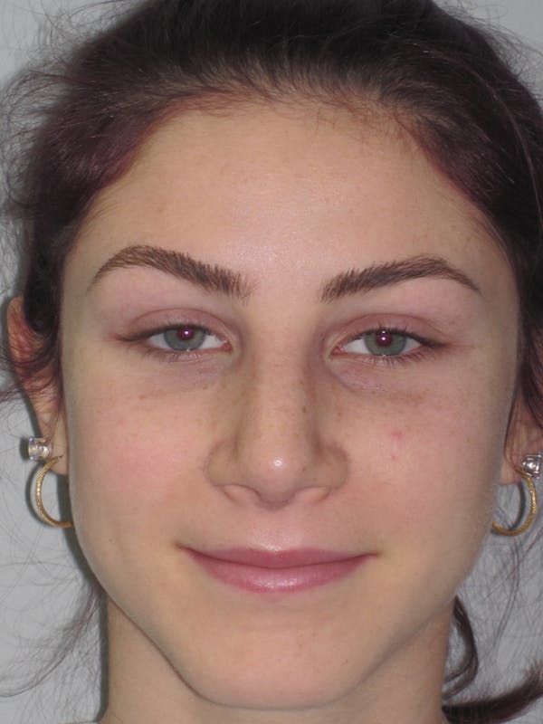 Rhinoplasty Before & After Gallery - Patient 11109916 - Image 2