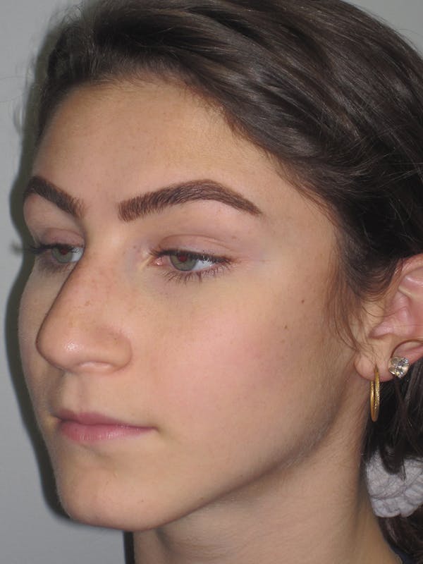 Rhinoplasty Before & After Gallery - Patient 11109916 - Image 5