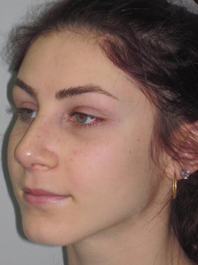 Rhinoplasty Before & After Gallery - Patient 11109916 - Image 6