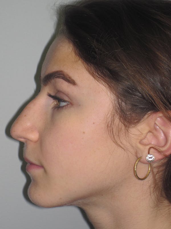 Rhinoplasty Before & After Gallery - Patient 11109916 - Image 3