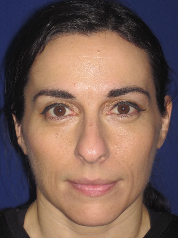 Rhinoplasty Before & After Gallery - Patient 11109917 - Image 7