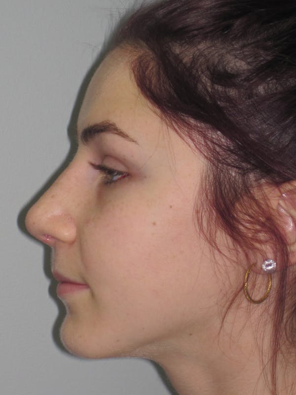 Rhinoplasty Before & After Gallery - Patient 11109916 - Image 4