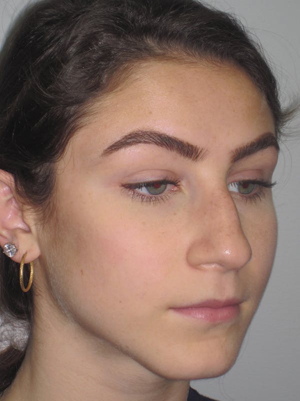 Rhinoplasty Before & After Gallery - Patient 11109916 - Image 7