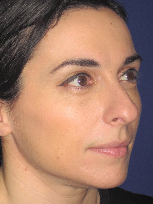Rhinoplasty Before & After Gallery - Patient 11109917 - Image 3