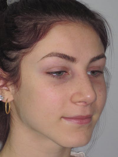 Rhinoplasty Before & After Gallery - Patient 11109916 - Image 8