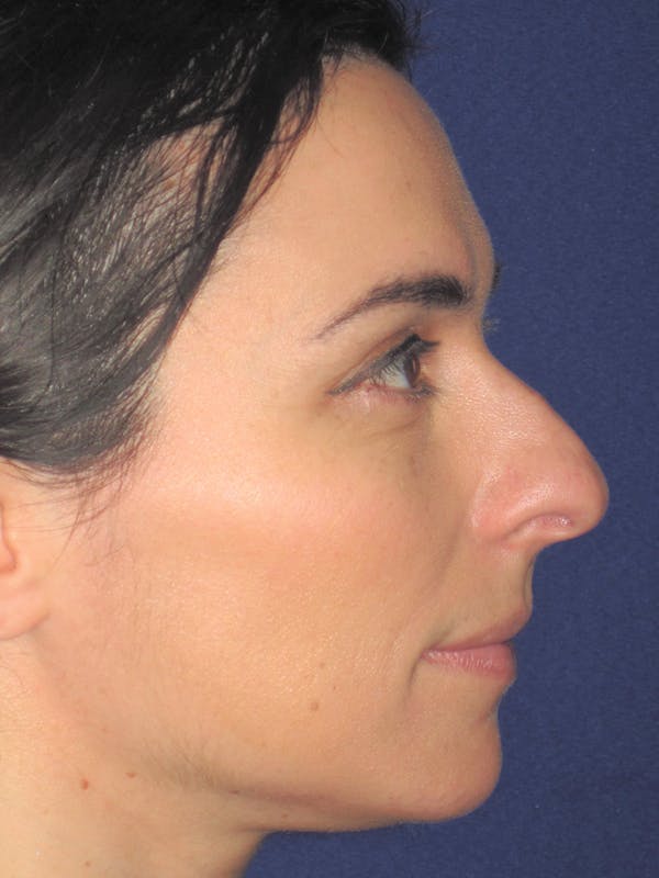 Rhinoplasty Before & After Gallery - Patient 11109917 - Image 5