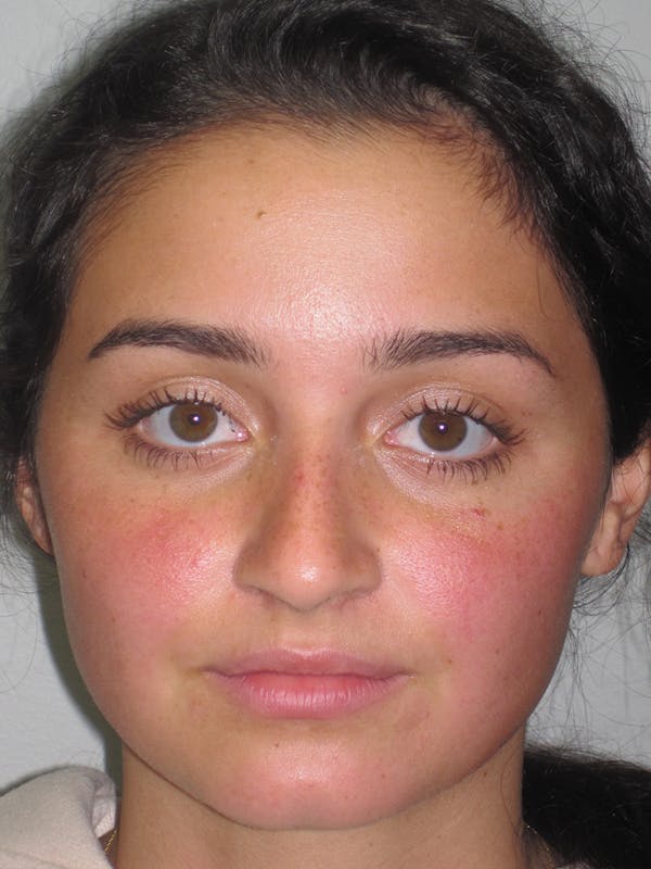 Rhinoplasty Before & After Gallery - Patient 11109918 - Image 3