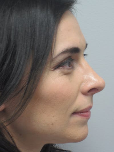 Rhinoplasty Before & After Gallery - Patient 11109917 - Image 6