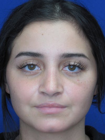 Rhinoplasty Before & After Gallery - Patient 11109918 - Image 4