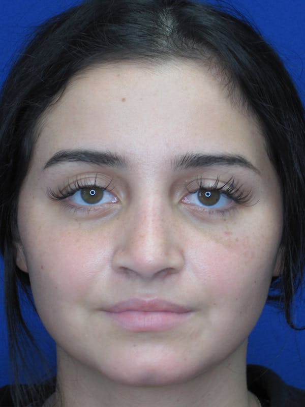 Rhinoplasty Before & After Gallery - Patient 11109918 - Image 4