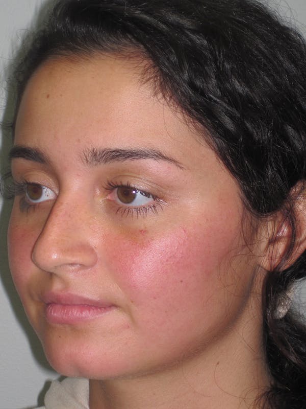 Rhinoplasty Before & After Gallery - Patient 11109918 - Image 5