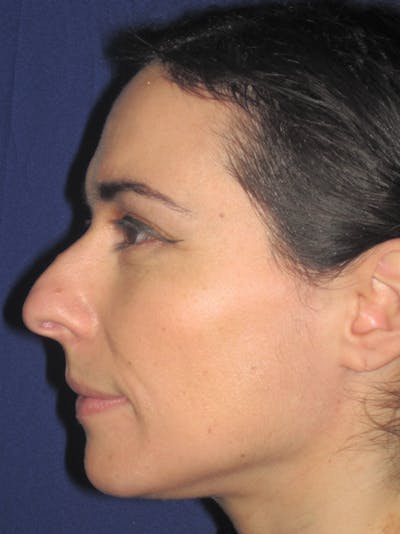Rhinoplasty Before & After Gallery - Patient 11109917 - Image 1