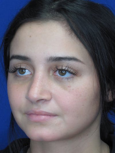 Rhinoplasty Before & After Gallery - Patient 11109918 - Image 6