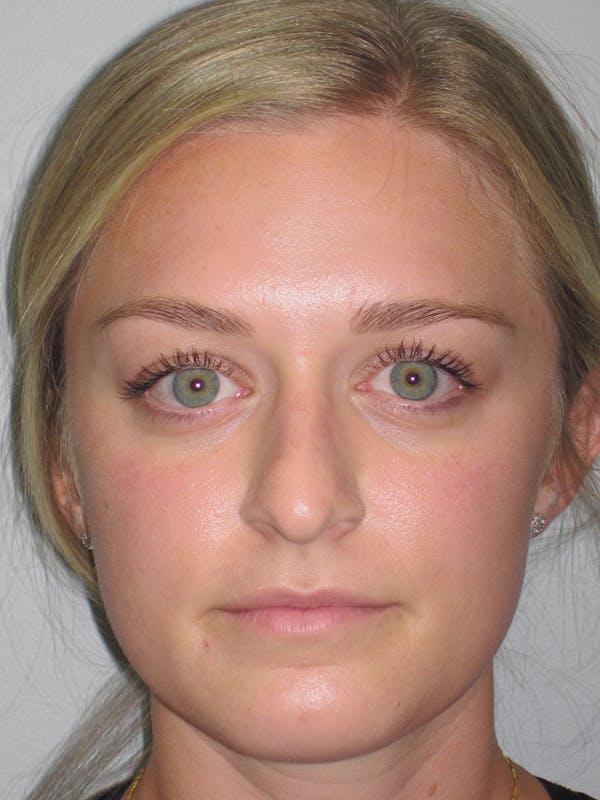 Rhinoplasty Before & After Gallery - Patient 11109919 - Image 5