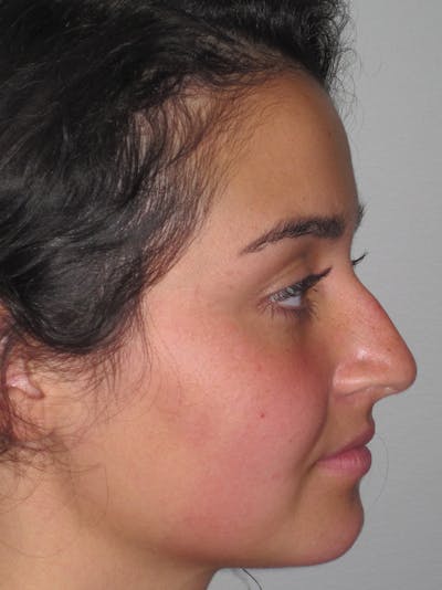Rhinoplasty Before & After Gallery - Patient 11109918 - Image 1