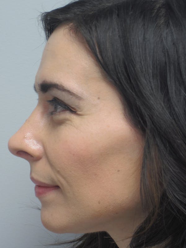 Rhinoplasty Before & After Gallery - Patient 11109917 - Image 2