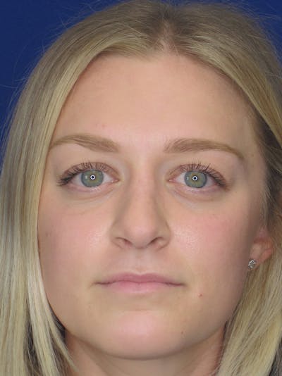 Rhinoplasty Before & After Gallery - Patient 11109919 - Image 6
