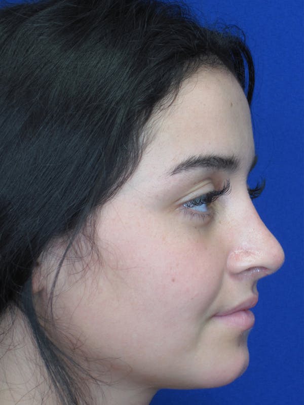 Rhinoplasty Before & After Gallery - Patient 11109918 - Image 2
