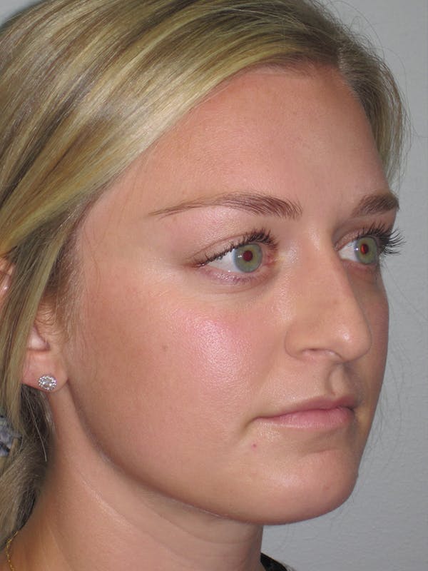 Rhinoplasty Before & After Gallery - Patient 11109919 - Image 3