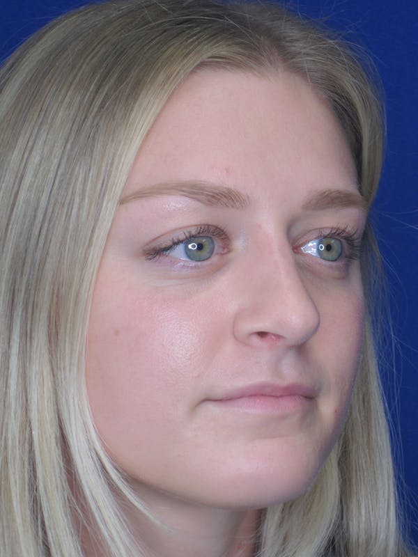 Rhinoplasty Before & After Gallery - Patient 11109919 - Image 4