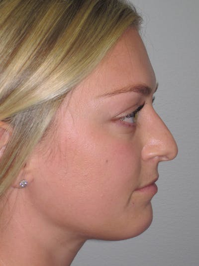 Rhinoplasty Before & After Gallery - Patient 11109919 - Image 1