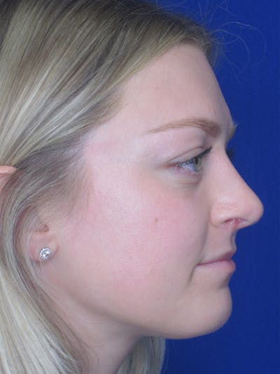 Rhinoplasty Before & After Gallery - Patient 11109919 - Image 2