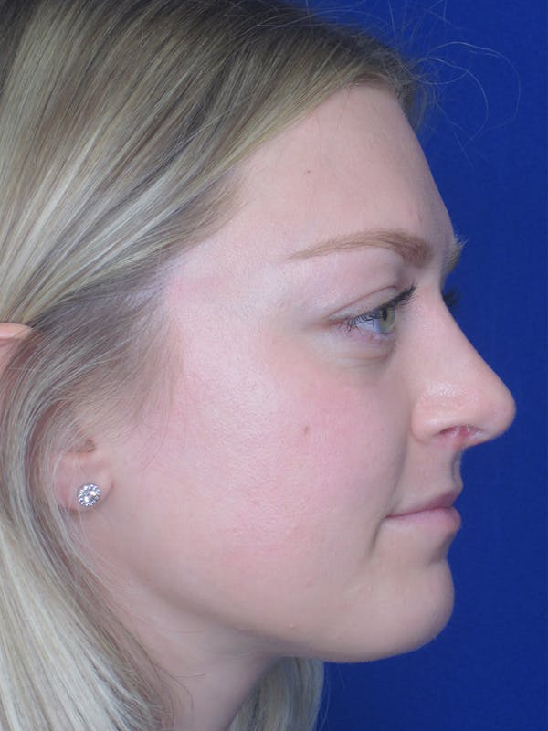 Rhinoplasty Before & After Gallery - Patient 11109919 - Image 2