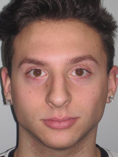 Rhinoplasty Before & After Gallery - Patient 11110017 - Image 1